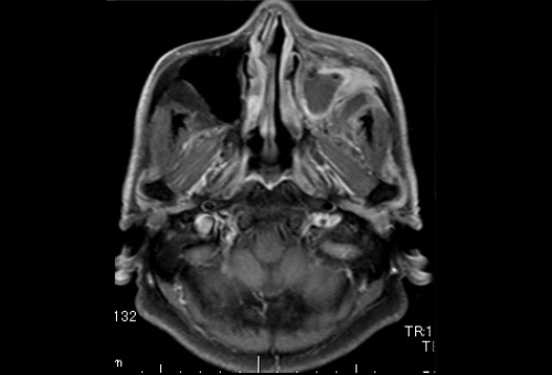 1ヵ月後MRI