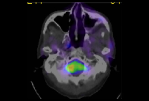 4ヵ月後PET-CT