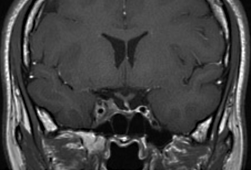 46ヵ月後　腫瘍の著名な縮小