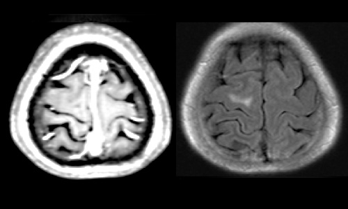 治療一ヶ月後　腫瘍、浮腫の消失